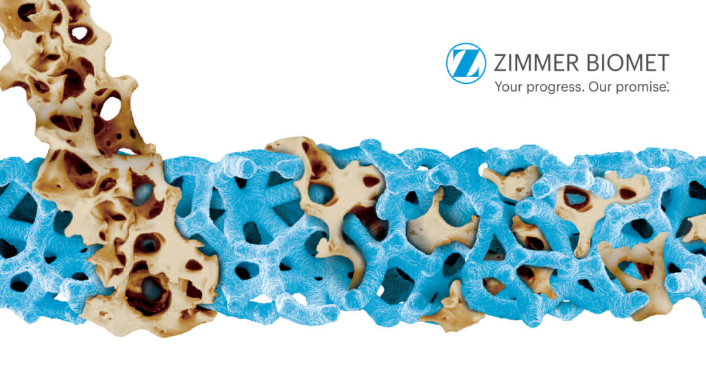 Zimmer Trabecular Metal - Zimmer Biomet Romania