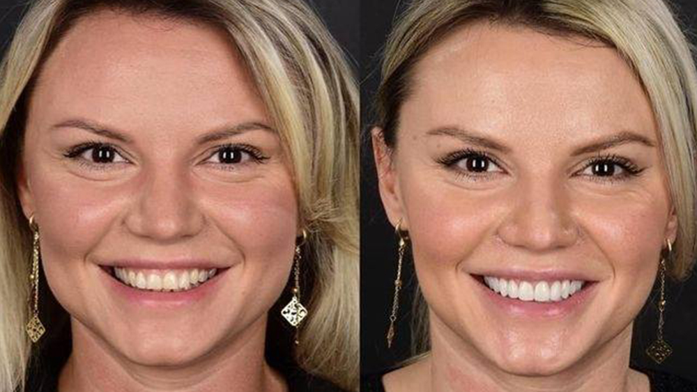 caz-11-inainte-si-dupa