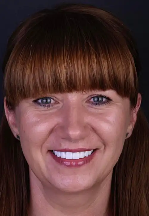 caz implanturi dentare