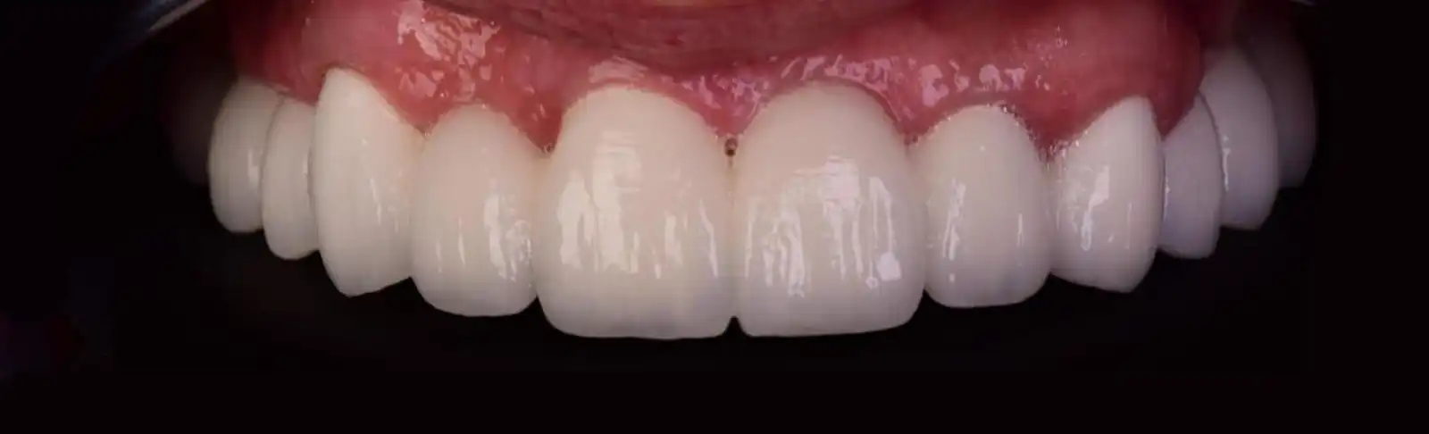 implant-dentar-1 copy