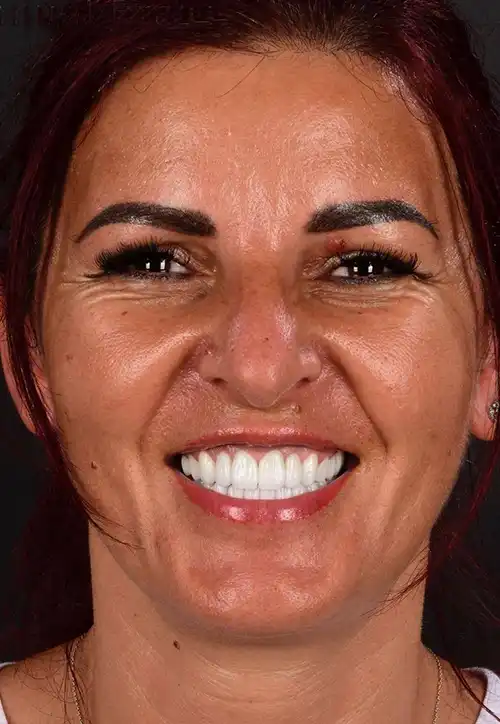 implant-dentar-pacient